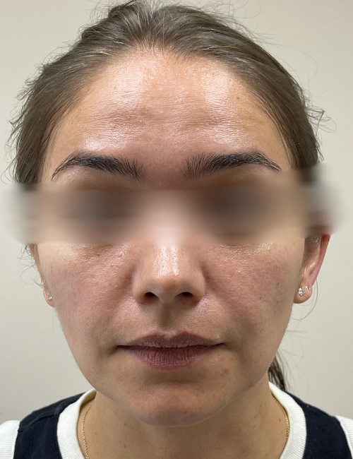 facetite results after