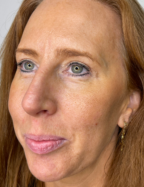 blepharoplasty after image