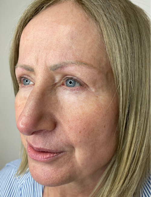 eyelid hooding before