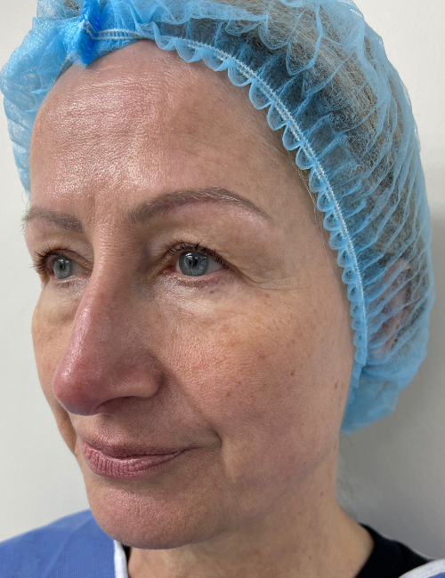 eyelid hooding after