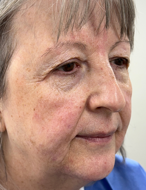 brow and bleph before