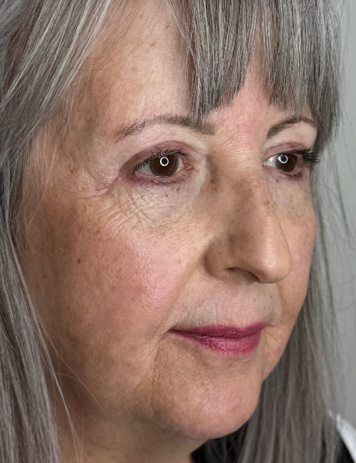 brow and bleph after