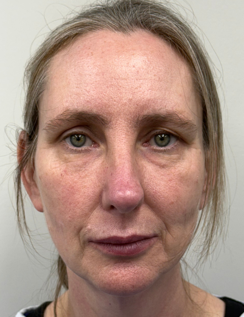 facelift before