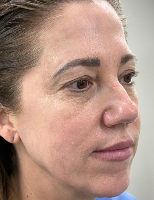 bleph and brow before