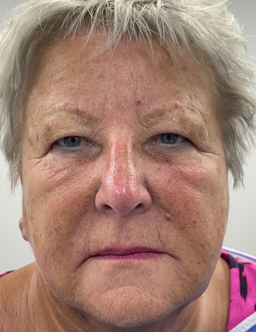 bleph before hooding