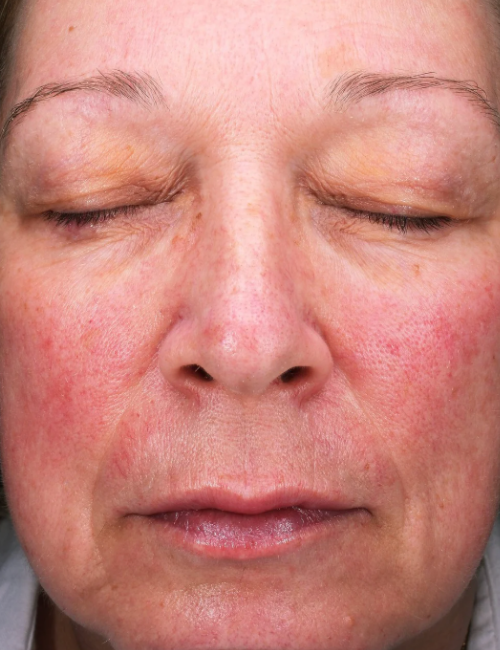 sylfirm and co2 before