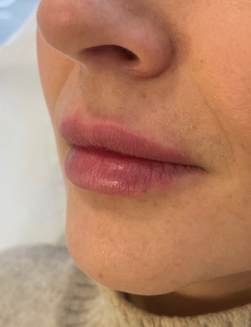 small lips after