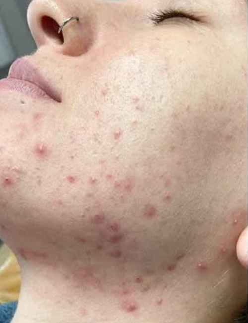 acne before peels