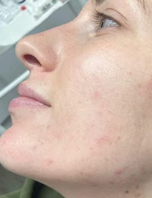 acne after peels