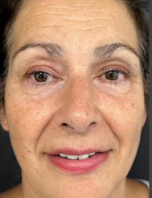 full face with filler before