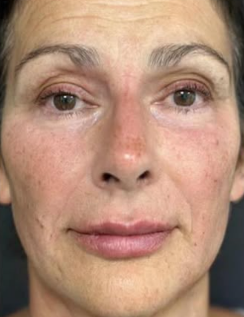 full face with filler after