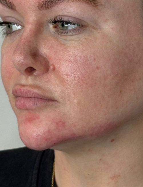 chin and jaw after filler