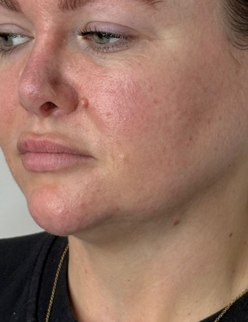 chin and jaw before filler