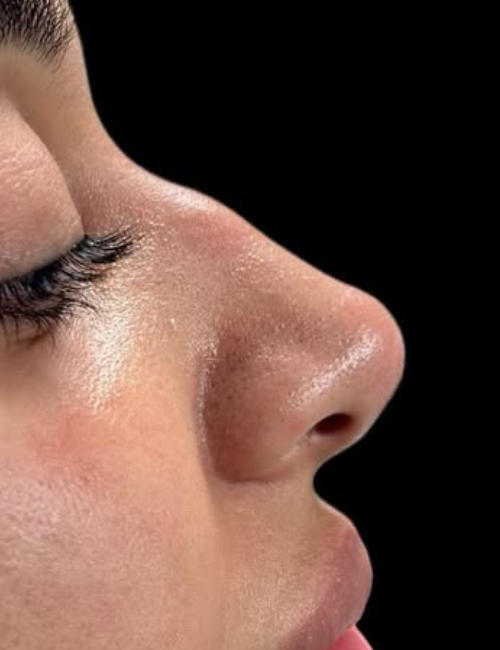 nose bump before filler