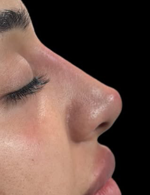 nose bump after filler