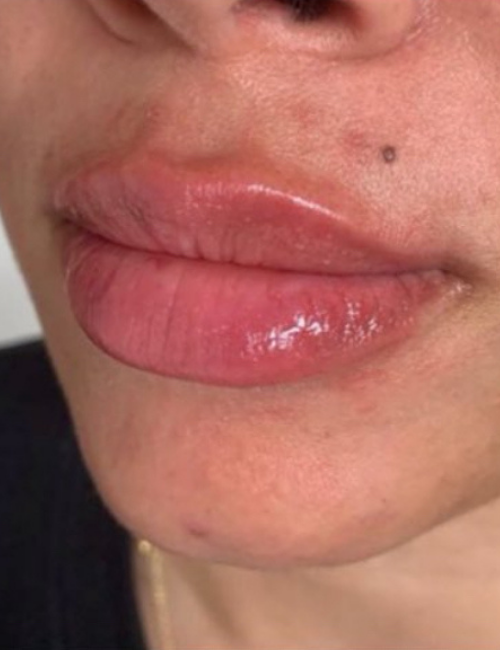 big lips with filler
