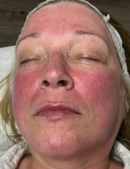 rosacea treatment
