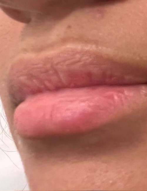 lip filler pre treatment