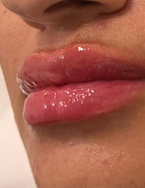 lip filler post treatment