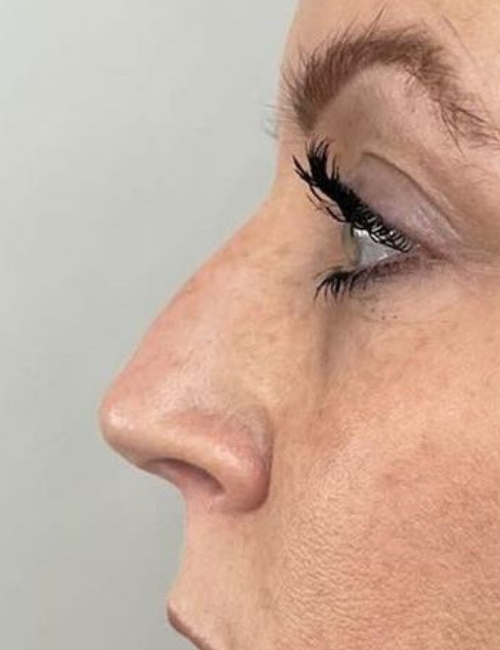 non surgical rhinoplasty before