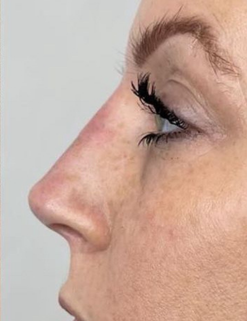 non surgical rhinoplasty after