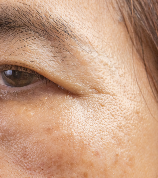 asian eyelid hooding