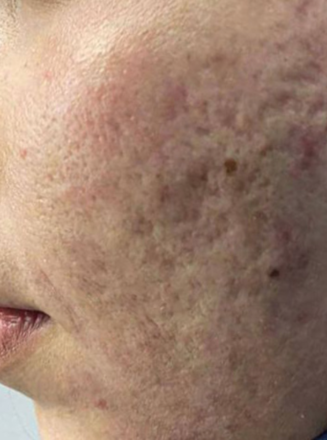 acne scars before co2