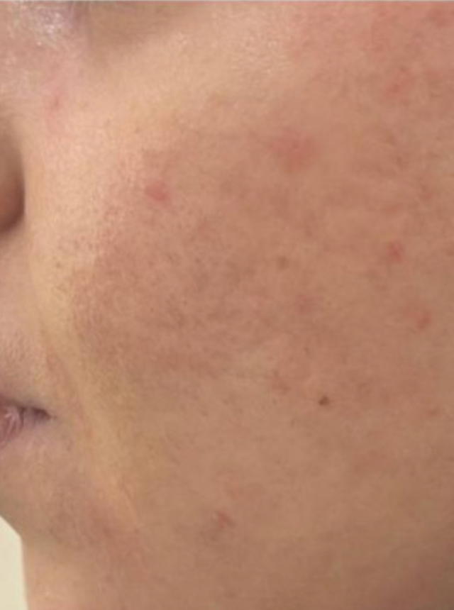 acne scars after co2