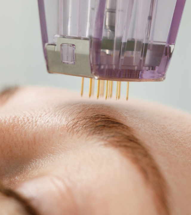 How Many Years Does Morpheus8 Last?