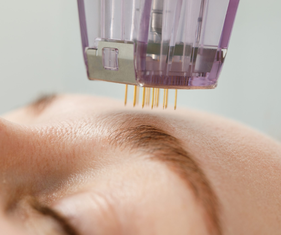 How Many Years Does Morpheus8 Last?