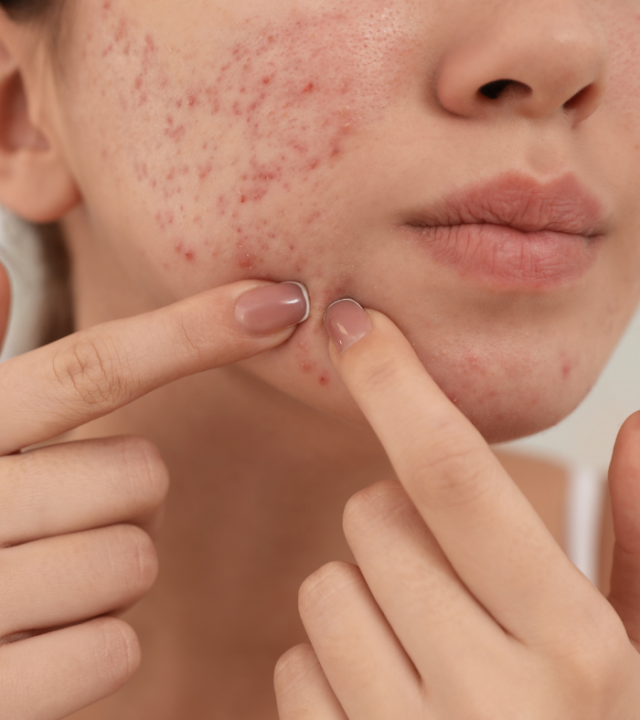 Hormonal or Bacterial acne