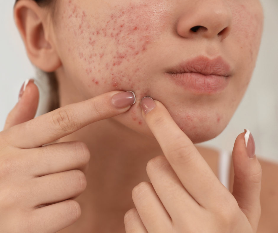 Hormonal or Bacterial acne