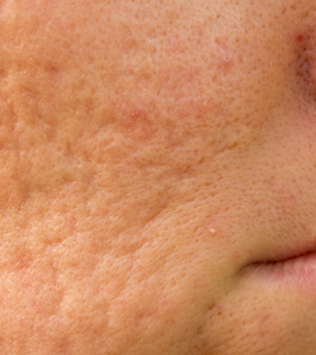 How SRGN Treats Acne Scars