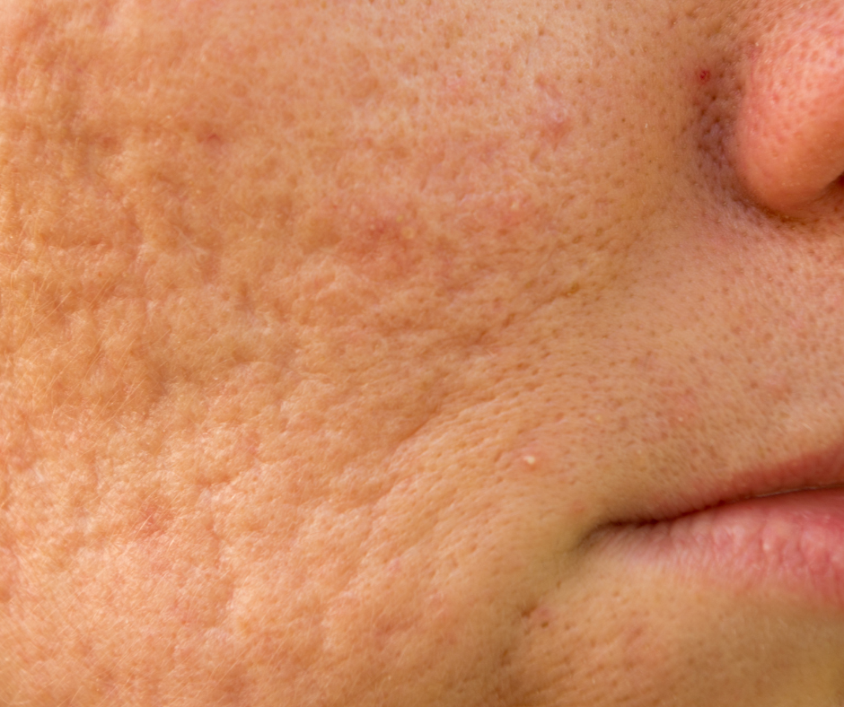 How SRGN Treats Acne Scars