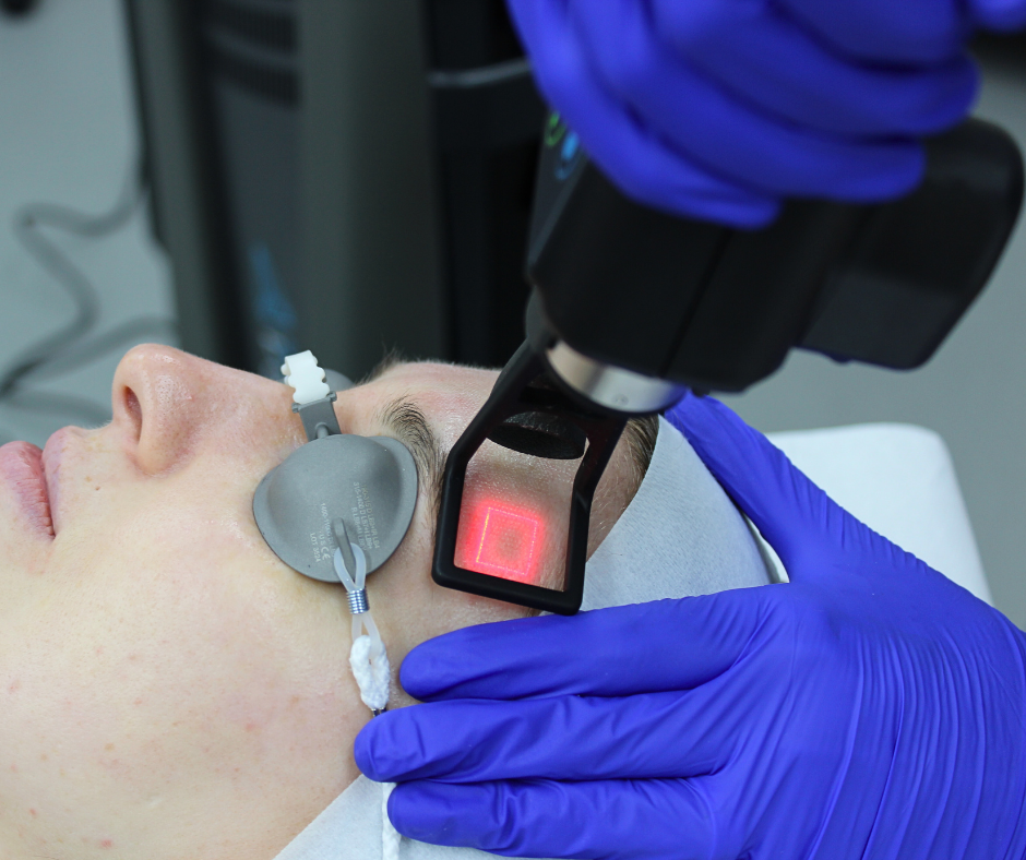 CO2 Laser for Scars, Benefits and Timing.