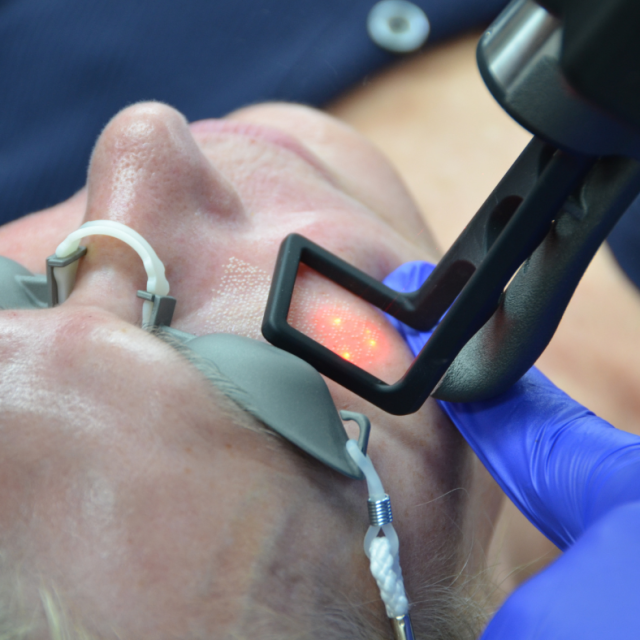 CO2 Laser Resurfacing