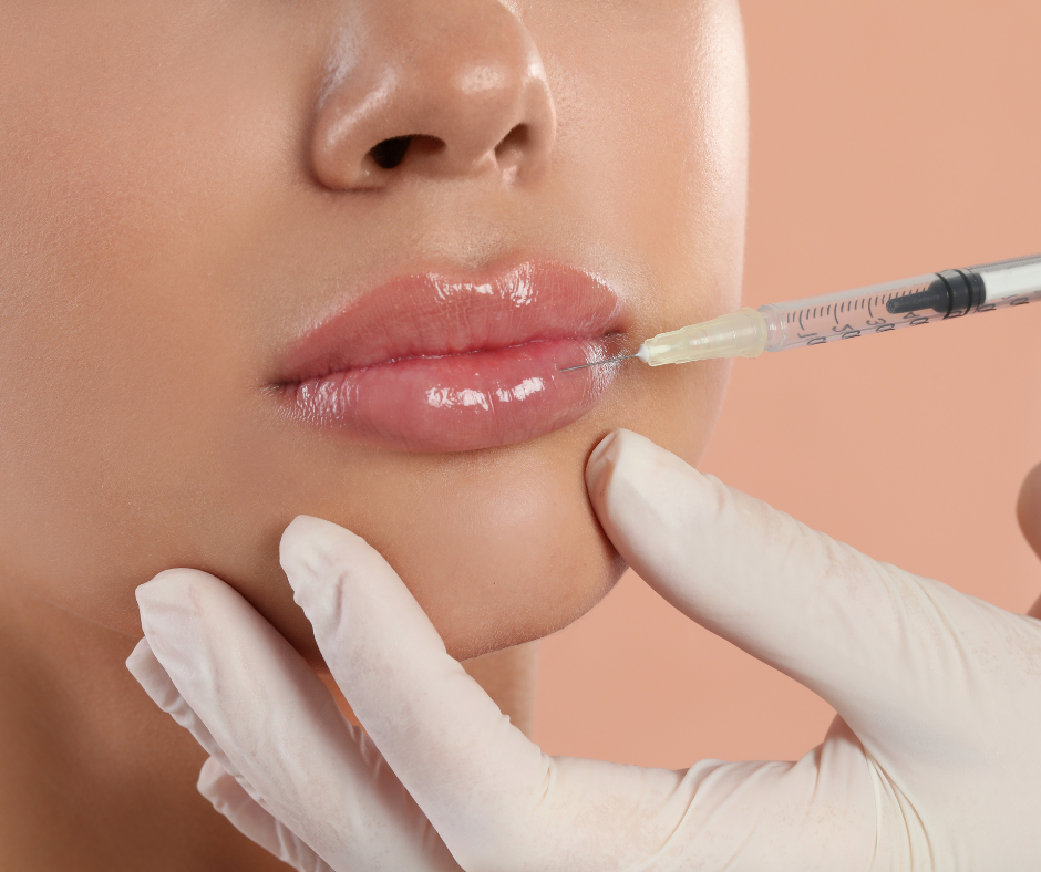 What You Need to Know About Lip Fillers