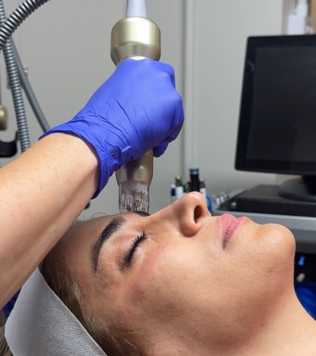 SylfirmX vs. Traditional Microneedling