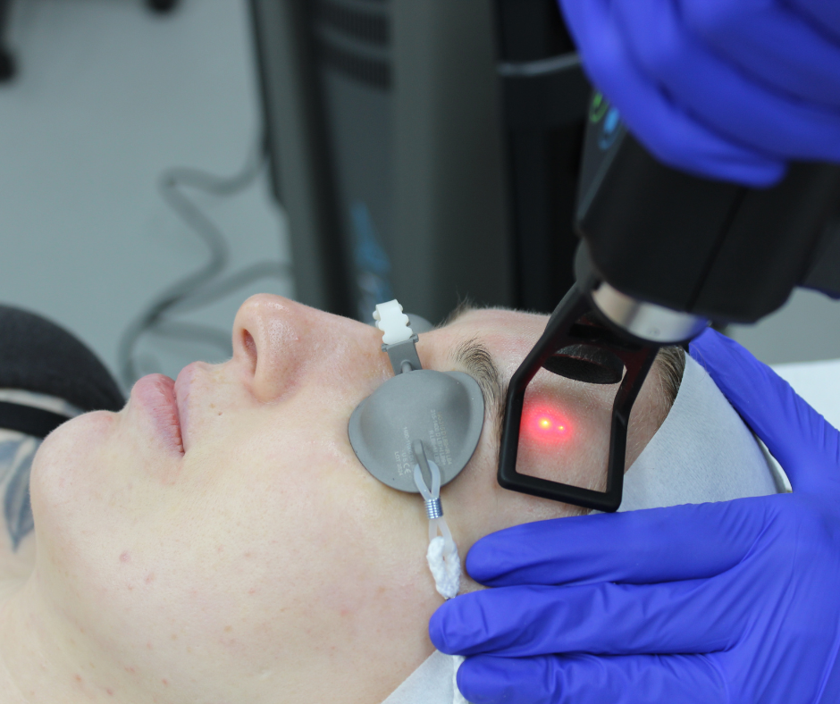 What Age is Best for CO2 Laser Treatment?