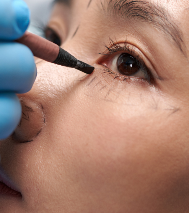 What Will I Look Like Immediately After Lower Blepharoplasty?