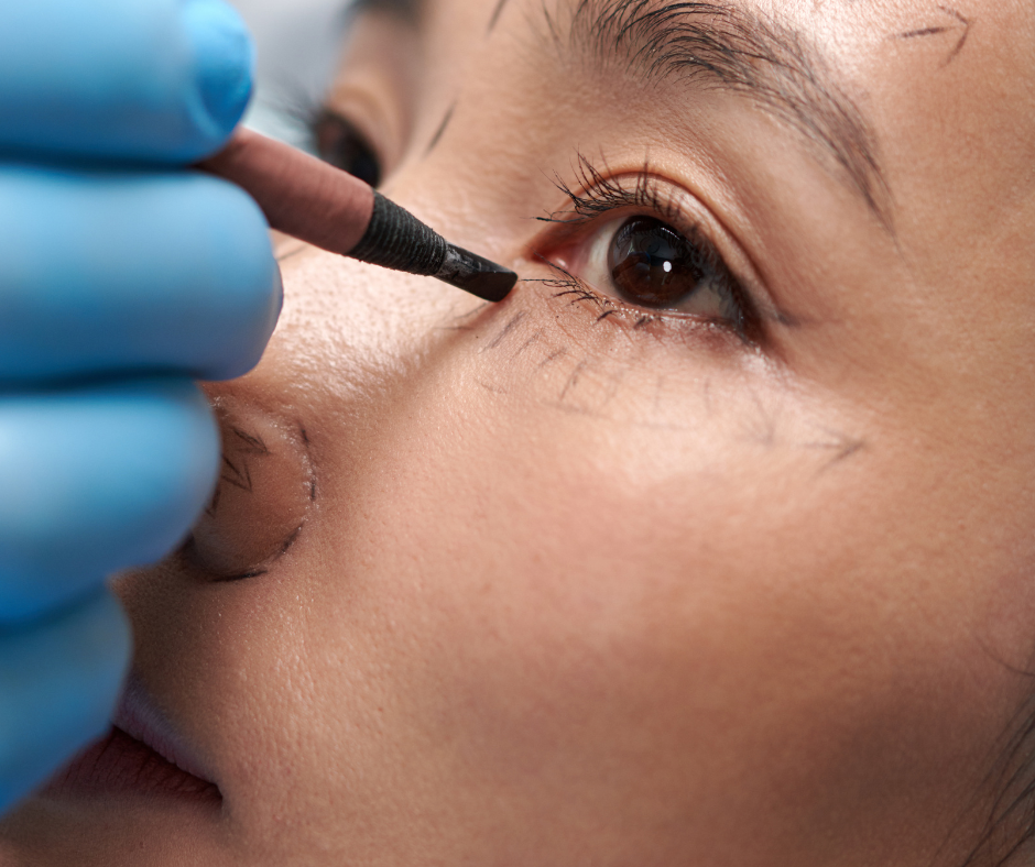 What Will I Look Like Immediately After Lower Blepharoplasty?