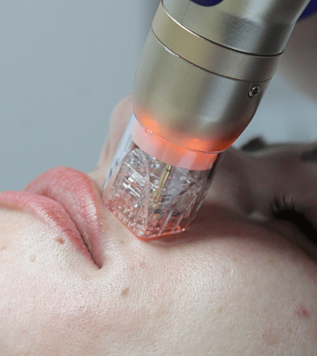 skin tightening with sylfirm x