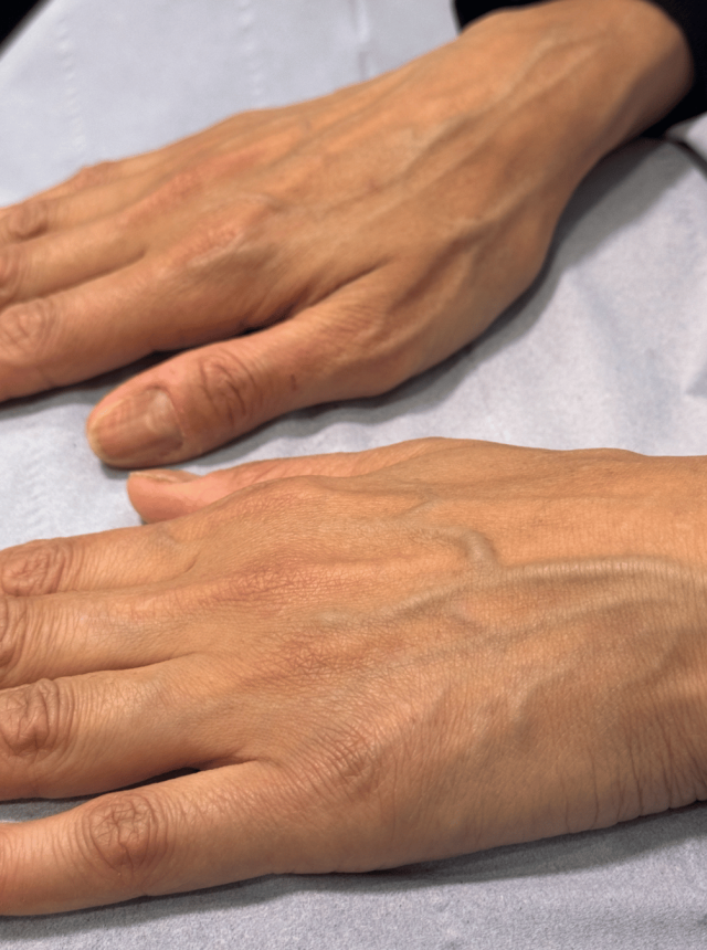 hand treatment before