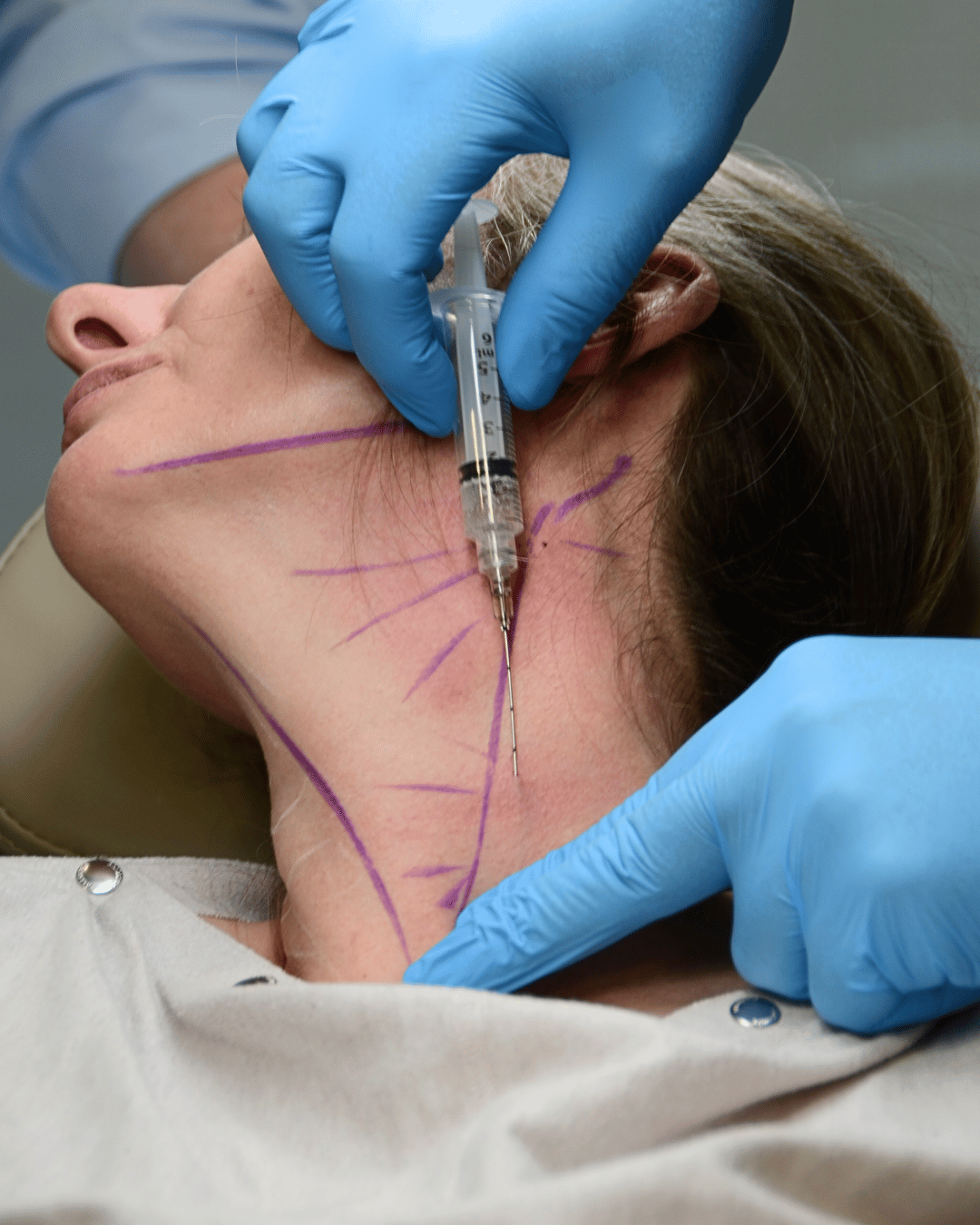 sculptra neck treatment in clinic