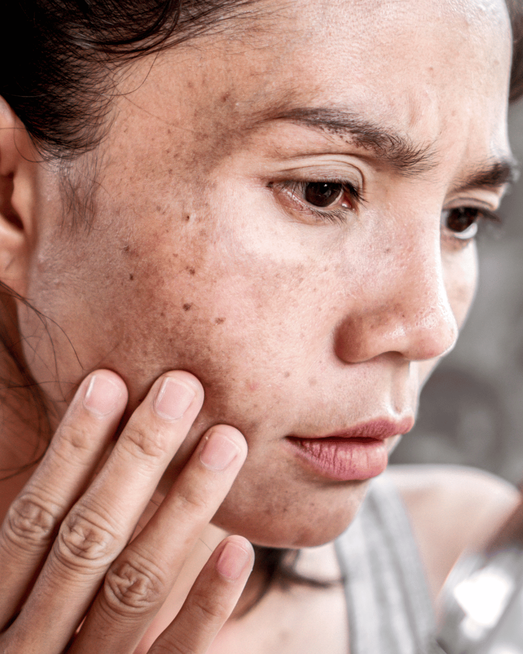 sun damaged side of face