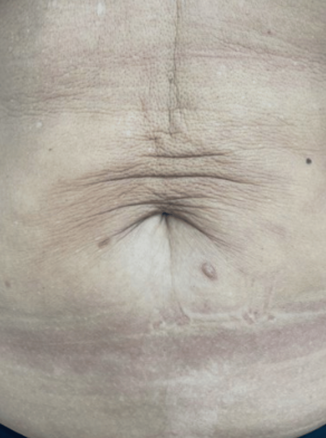 skin tightening before image