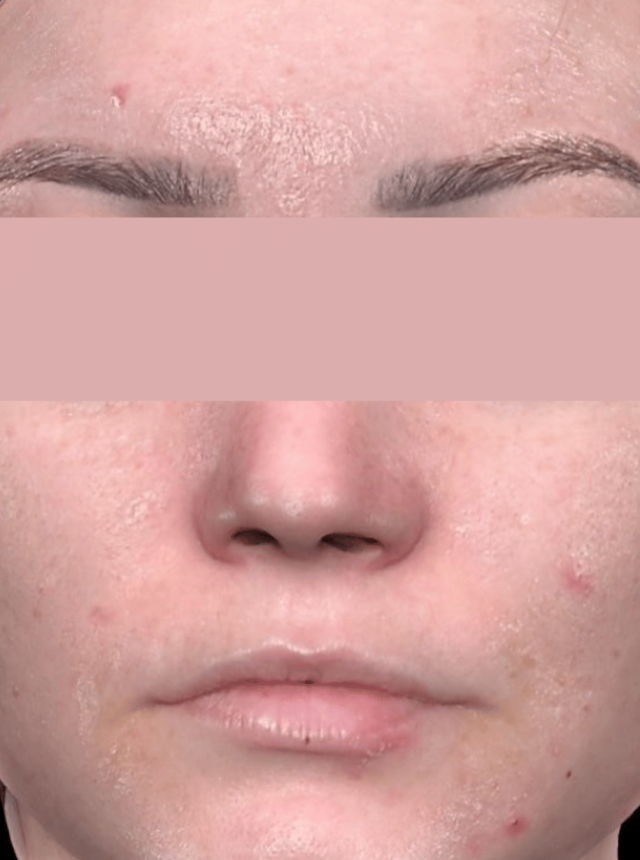 coolpeel laser before