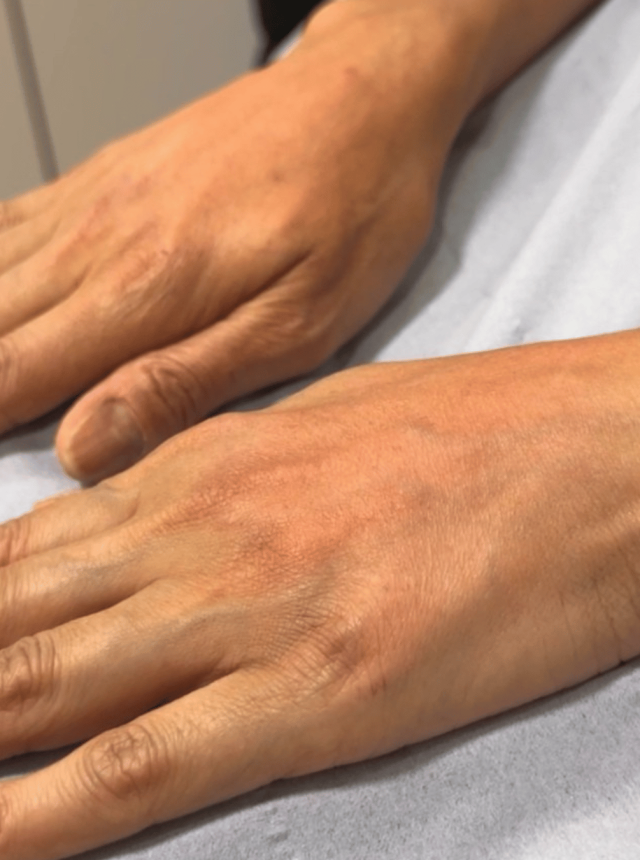 hand treatment after