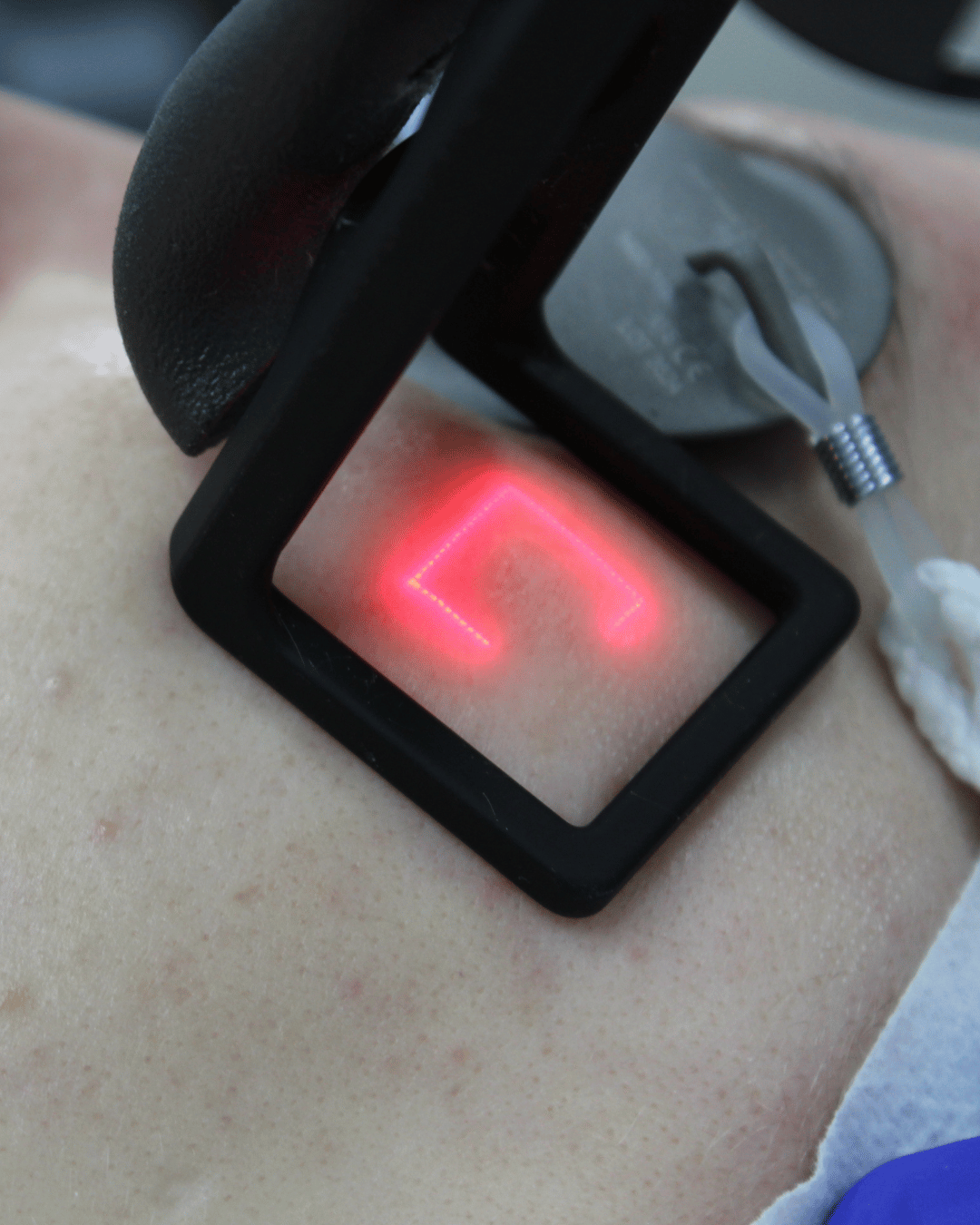 co2 for sun damage skin