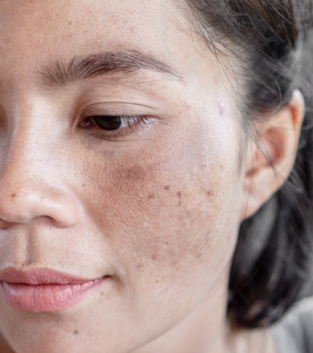 woman with sun damage